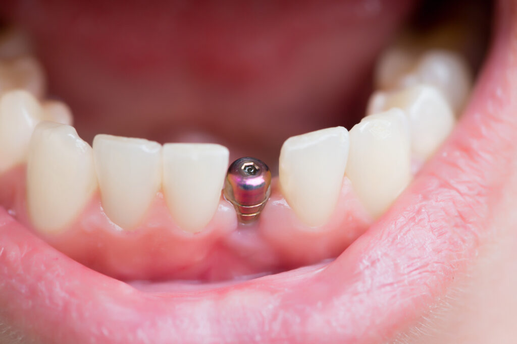 Preparing Yourself for Dental Implant Surgery