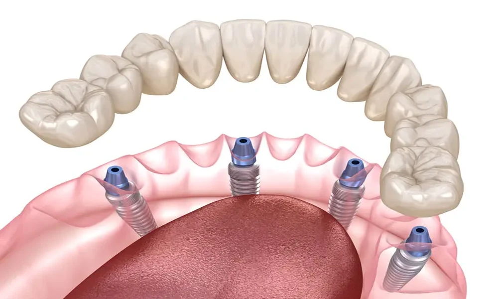 Bone Health and Dental Implants: Why Jaw Strength Matters More Than You Think