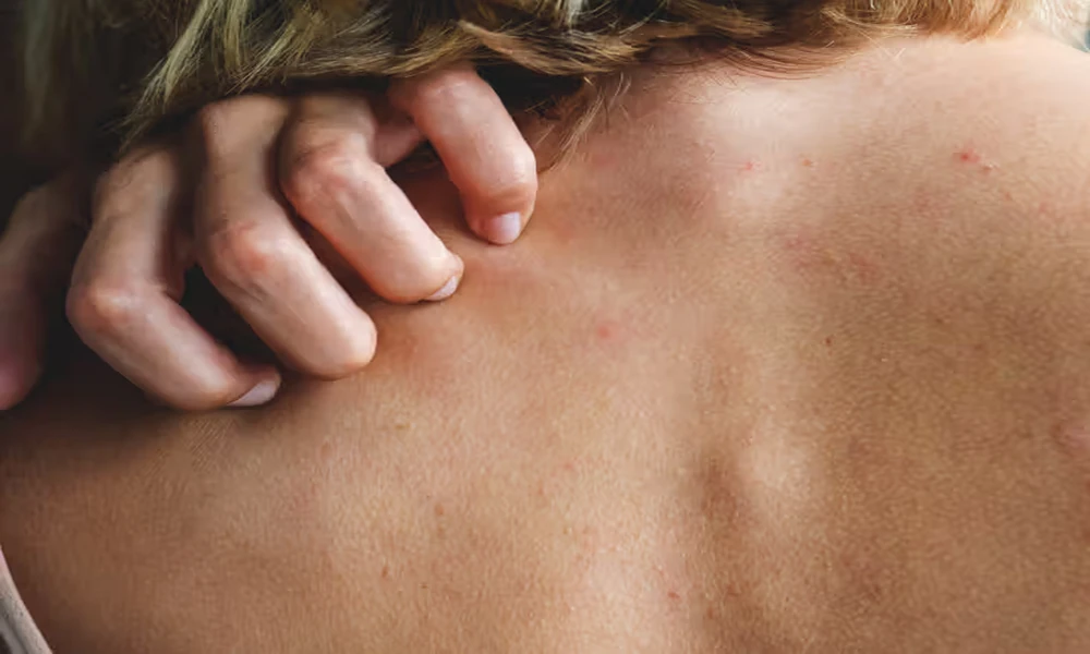 What Is the Difference Between a Side Effect and an Allergic Reaction?