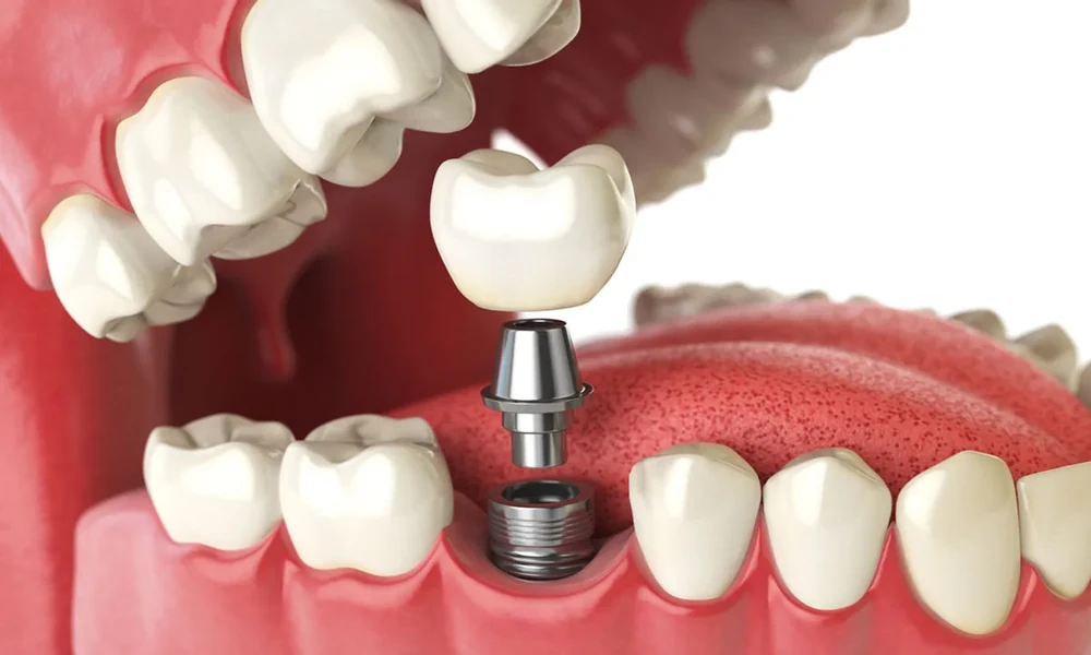 Why Regular Dental Visits Matter Even When Nothing Hurts
