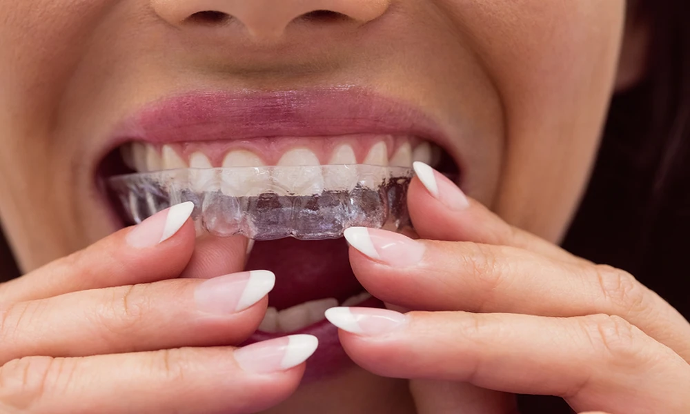 Which Foods Can Stain Teeth During Invisalign?