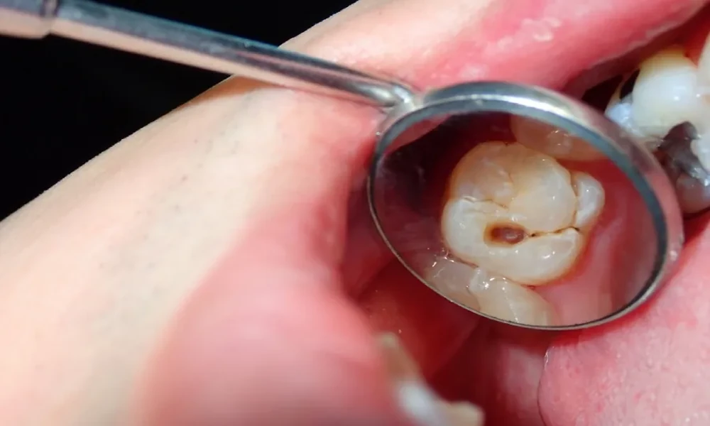 6 Questions Parents Often Have About Xylitol And Cavity Prevention