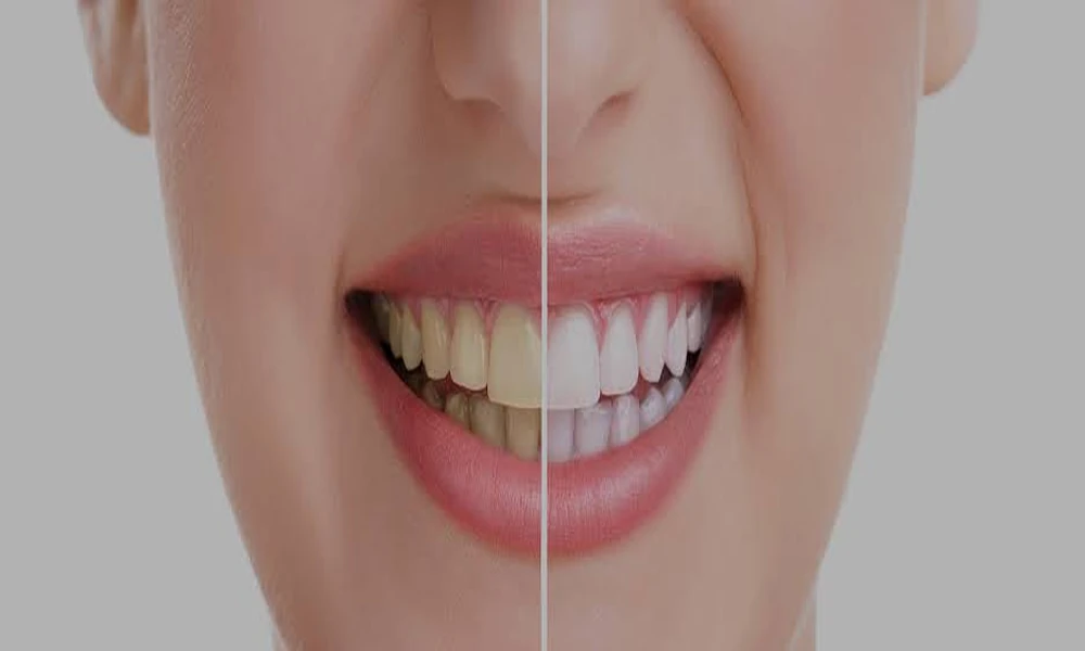 5 Reasons A Cosmetic Dentist May Recommend Removing A Tooth Gem